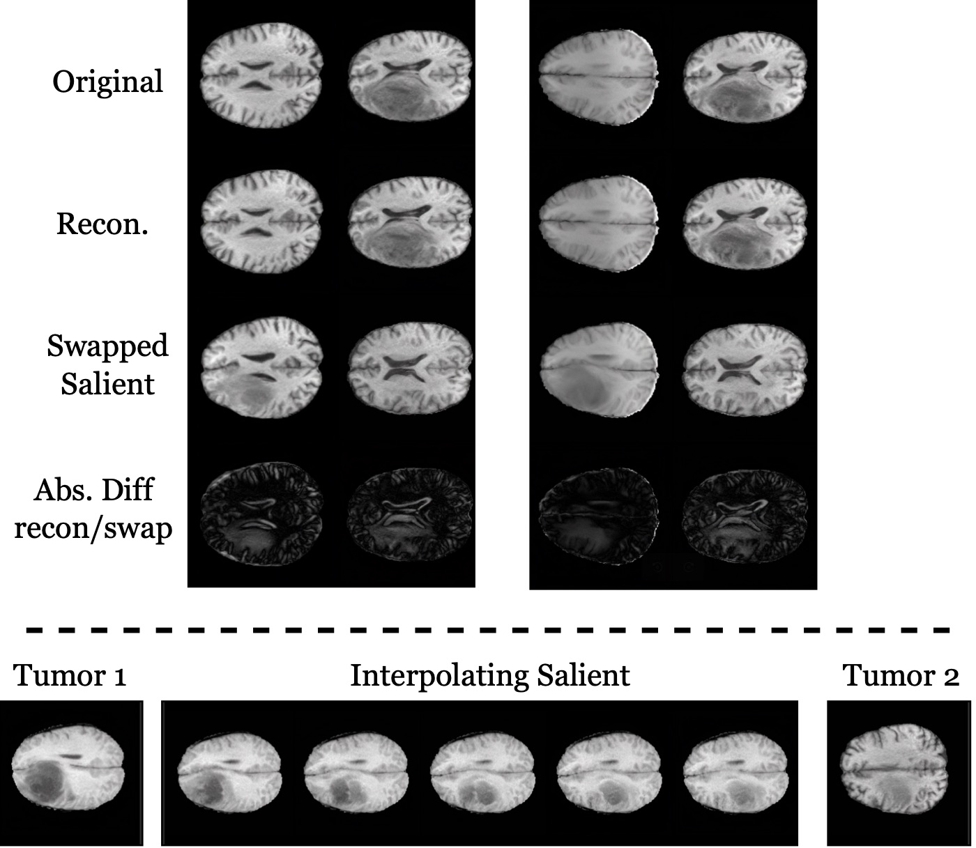 Brain MRI slices. Rows show originals, reconstructions, salient-swapped images and absolute differences: tumors are added to healthy slices and removed from pathological ones. Bottom: interpolation of the salient code between two tumors.